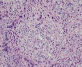 NeuroInsight brain glioma mutation prediction output